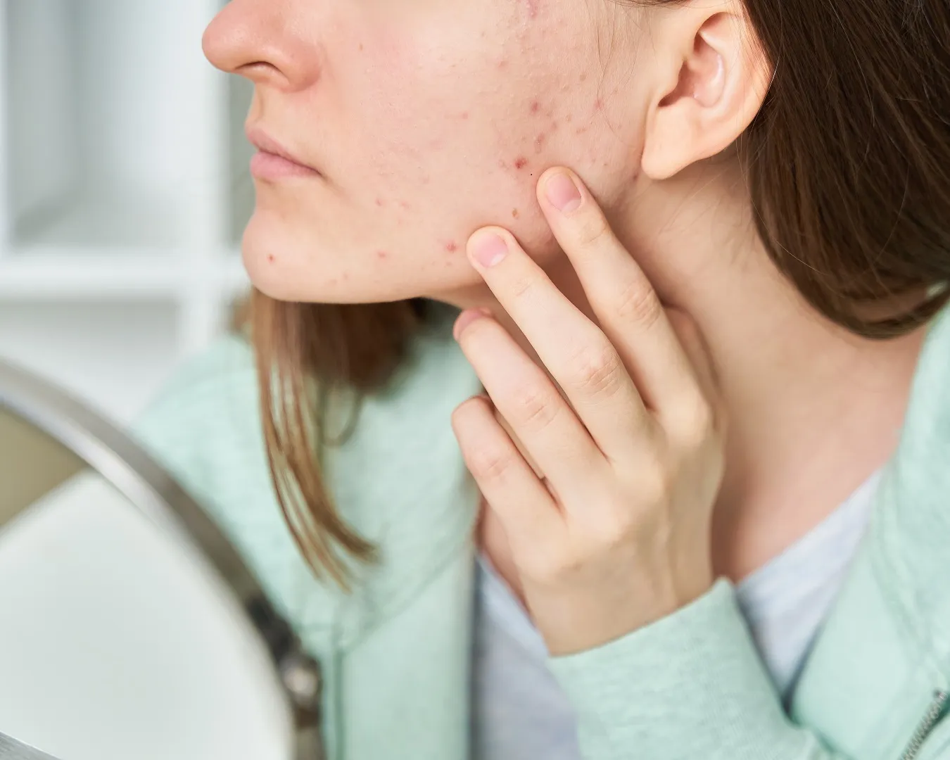 Determining the Right Ingredients for Acne Prone Skin 